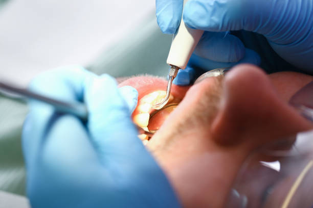Best Emergency Treatment for Dental Infections or Abscesses in Ashland, CA