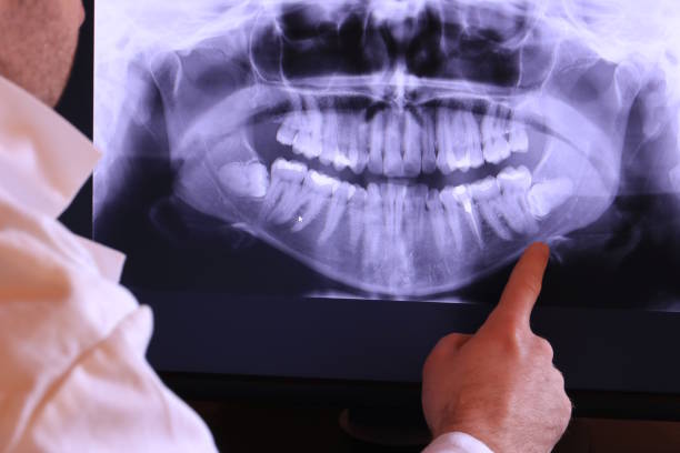 Best Emergency Treatment for Dental Infections or Abscesses in Ashland, CA